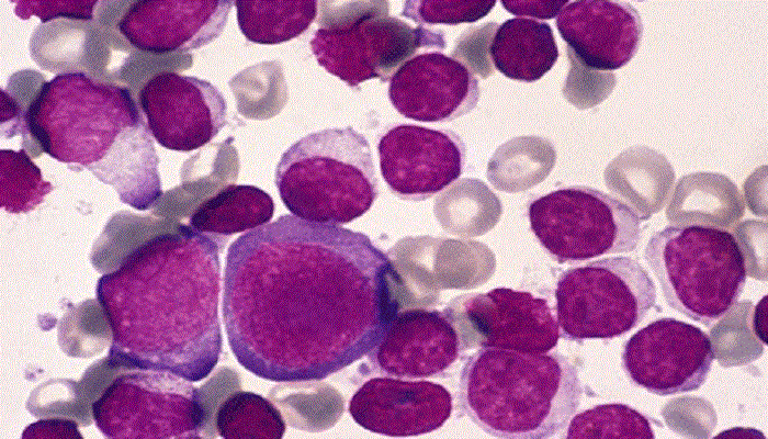 Cancerous white blood cells in leukemia